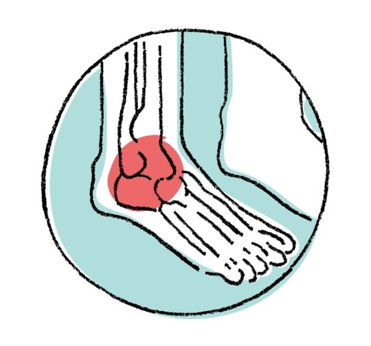 Diagram Of Inflammatory Arthritis In Ankle