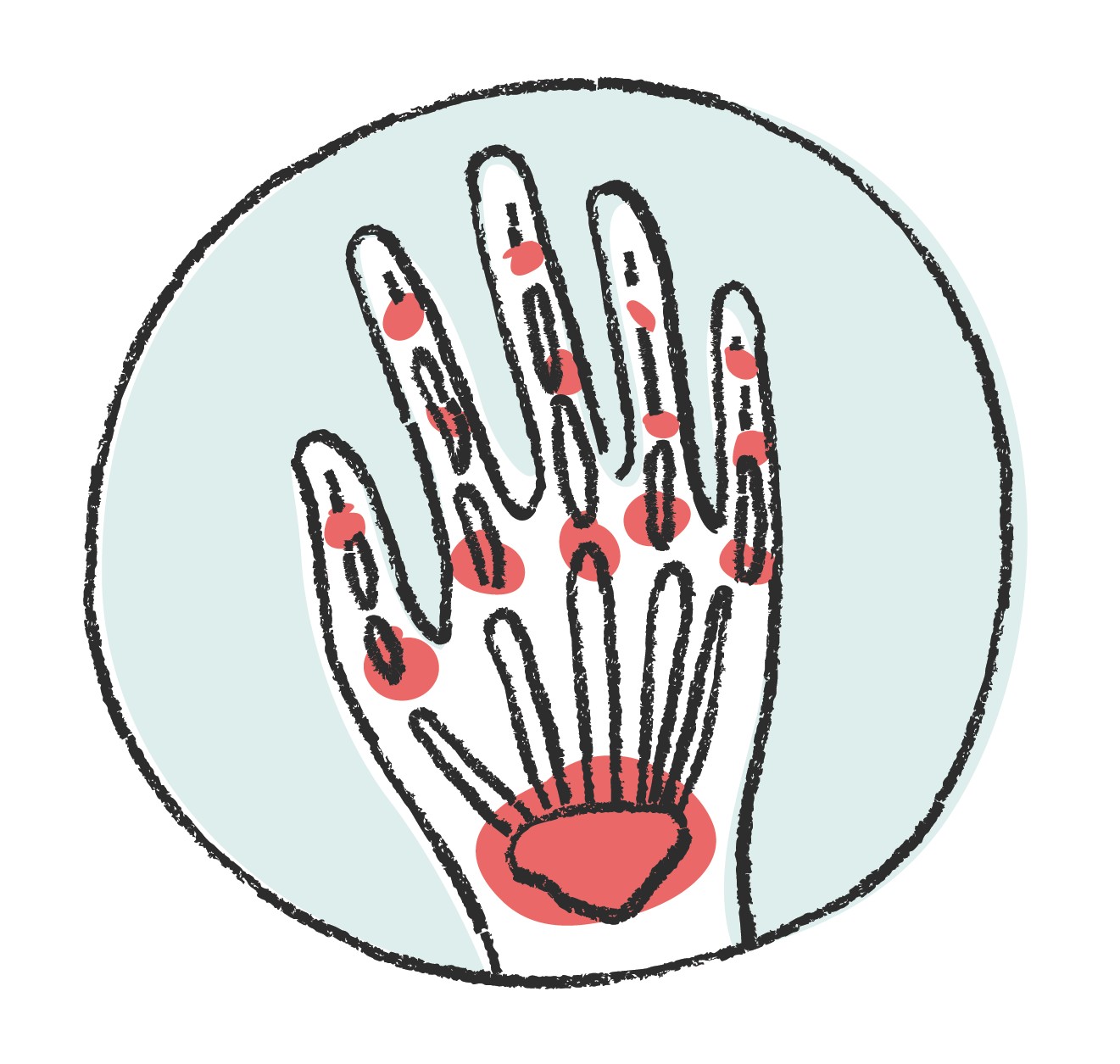 Diagram Of Inflammatory Arthritis In Hand